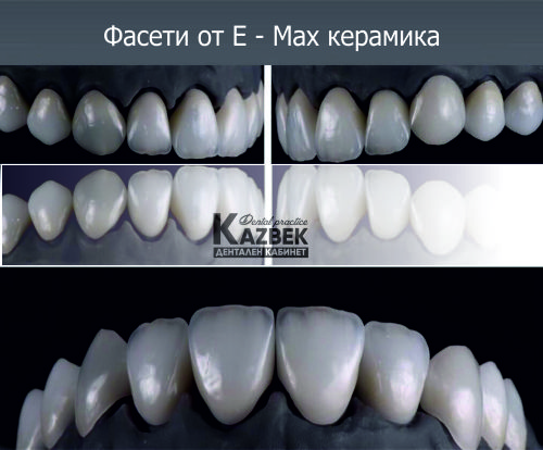 E Max керамични фасети