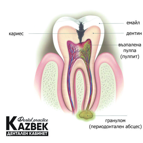 кариес и последствията от него